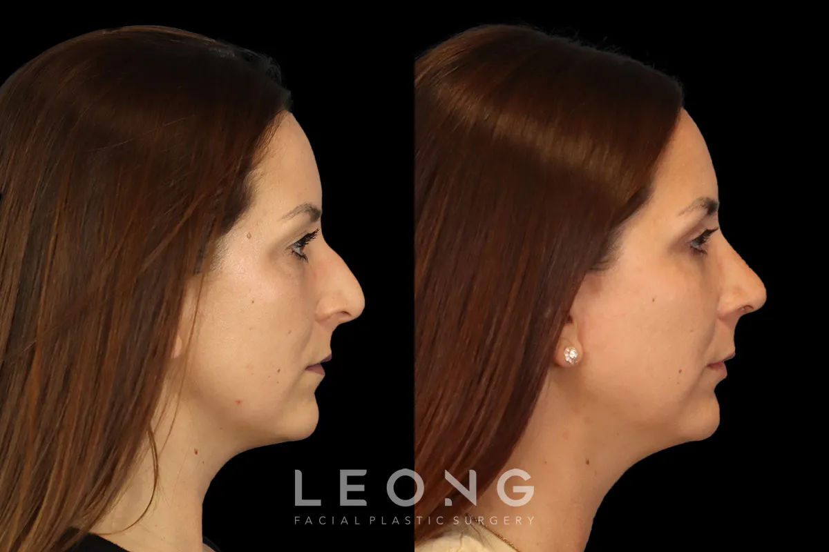 Rhinoplasty Before and After | Leong Facial Plastic Surgery