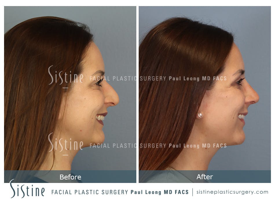Rhinoplasty Before and After | Leong Facial Plastic Surgery