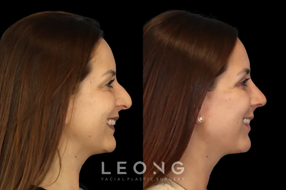 Rhinoplasty Before and After | Leong Facial Plastic Surgery