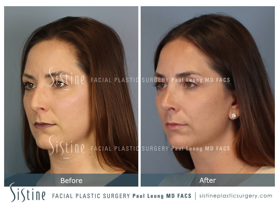 Rhinoplasty Before and After | Leong Facial Plastic Surgery