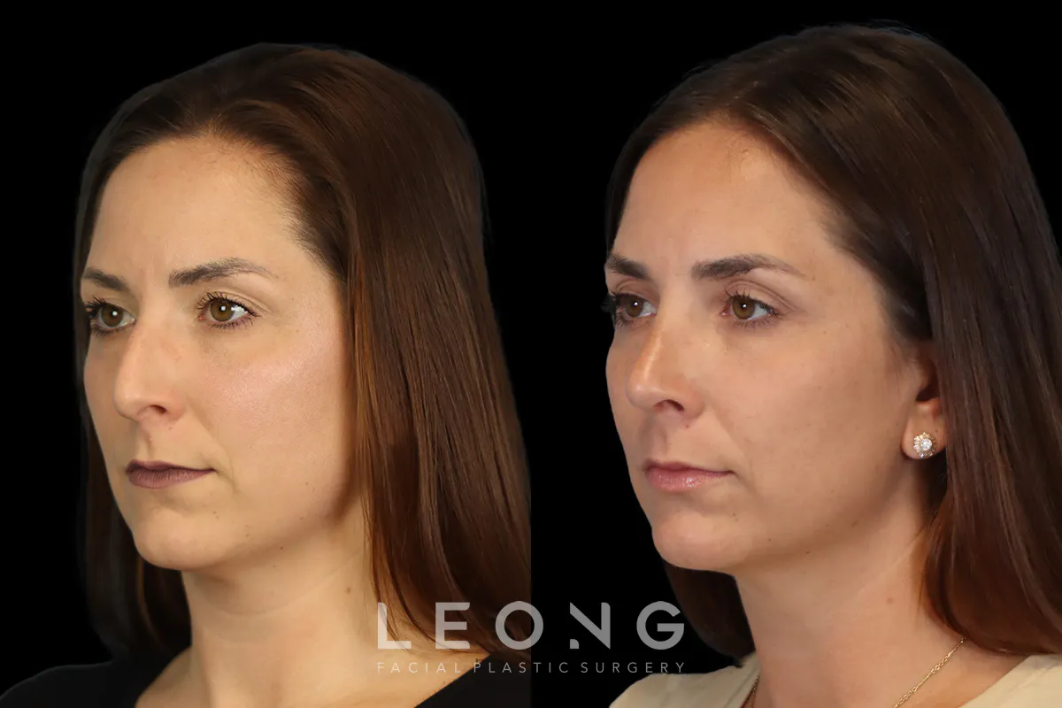Rhinoplasty Before and After | Leong Facial Plastic Surgery