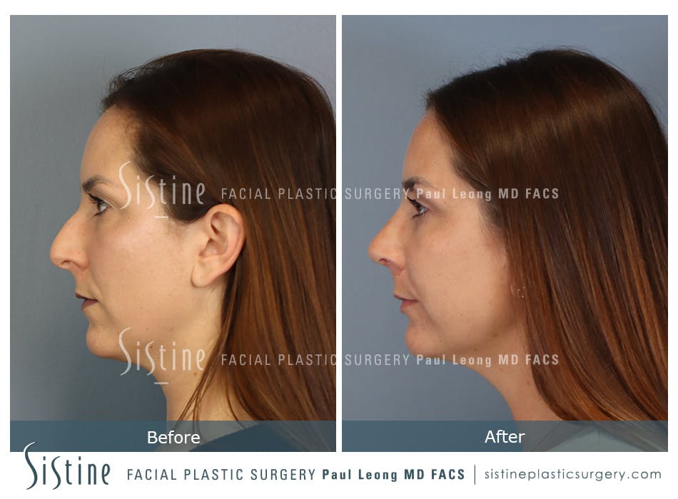 Rhinoplasty Before and After | Leong Facial Plastic Surgery