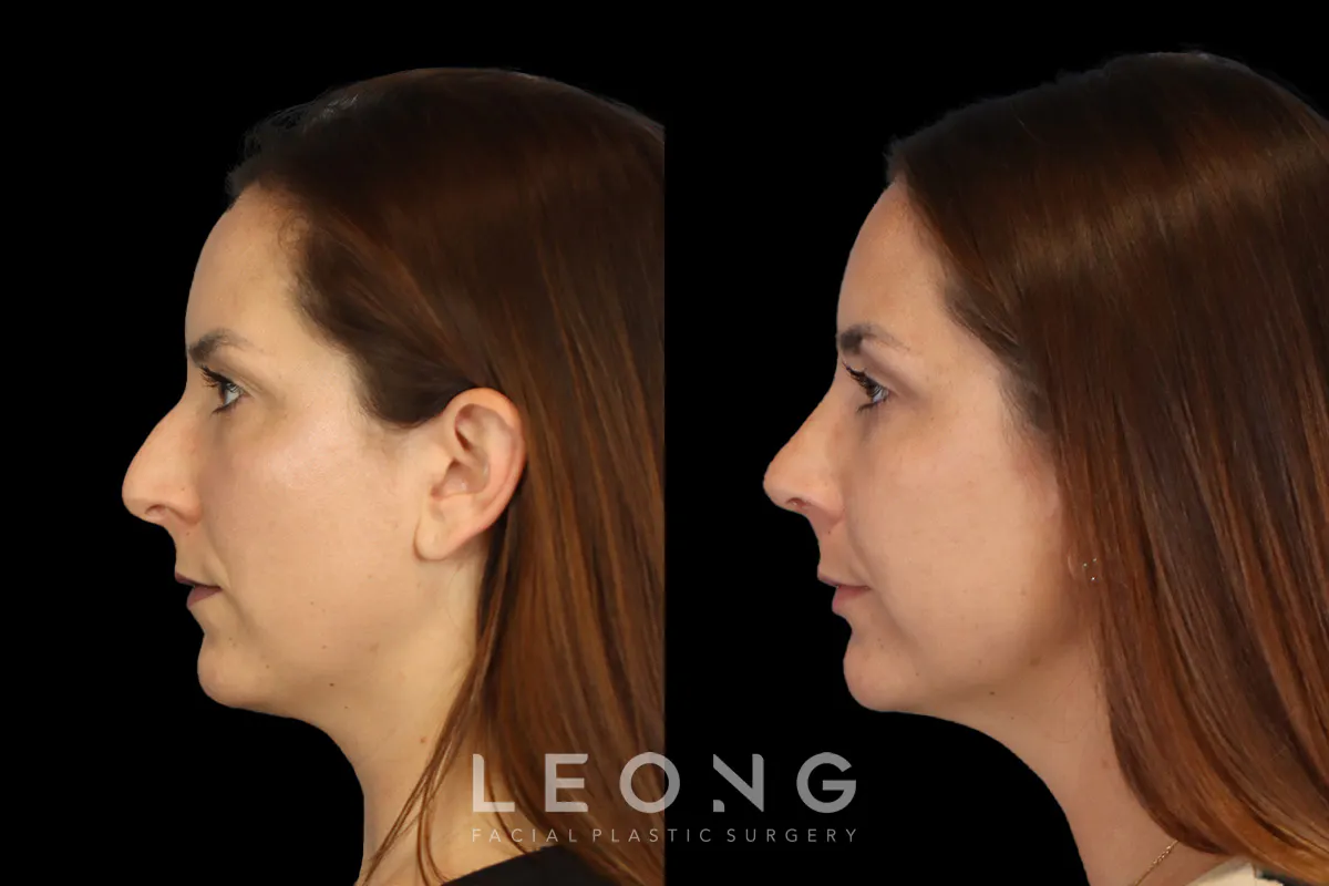 Rhinoplasty Before and After | Leong Facial Plastic Surgery