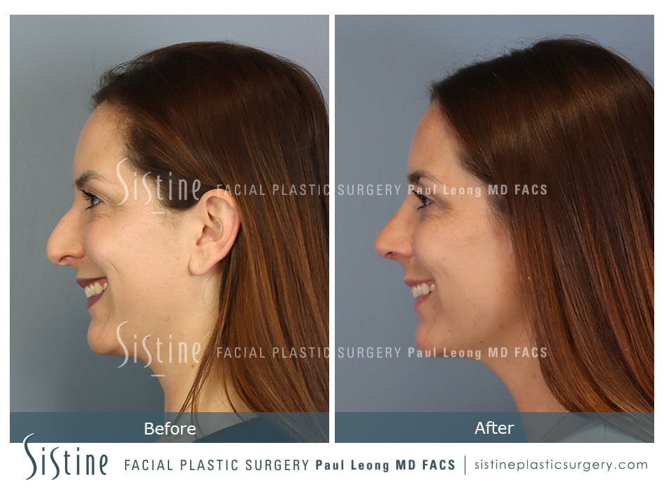 Rhinoplasty Before and After | Leong Facial Plastic Surgery