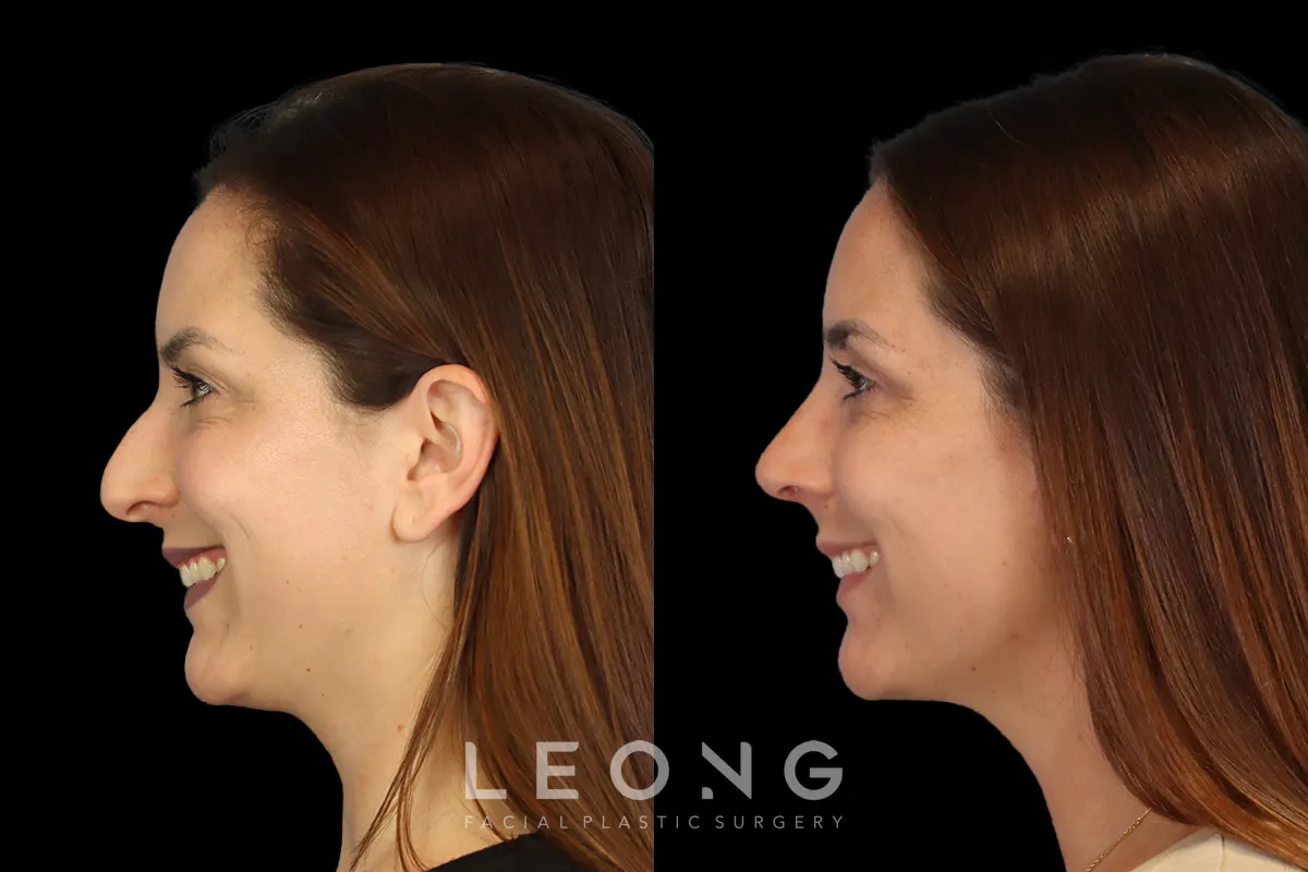 Rhinoplasty Before and After | Leong Facial Plastic Surgery