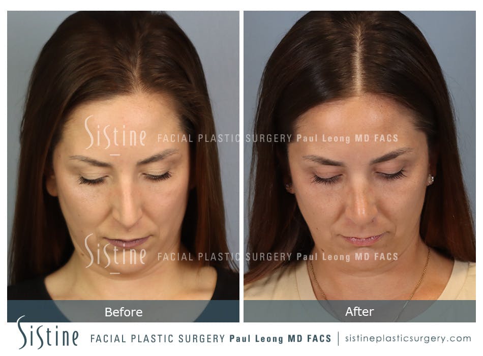 Rhinoplasty Before and After | Leong Facial Plastic Surgery