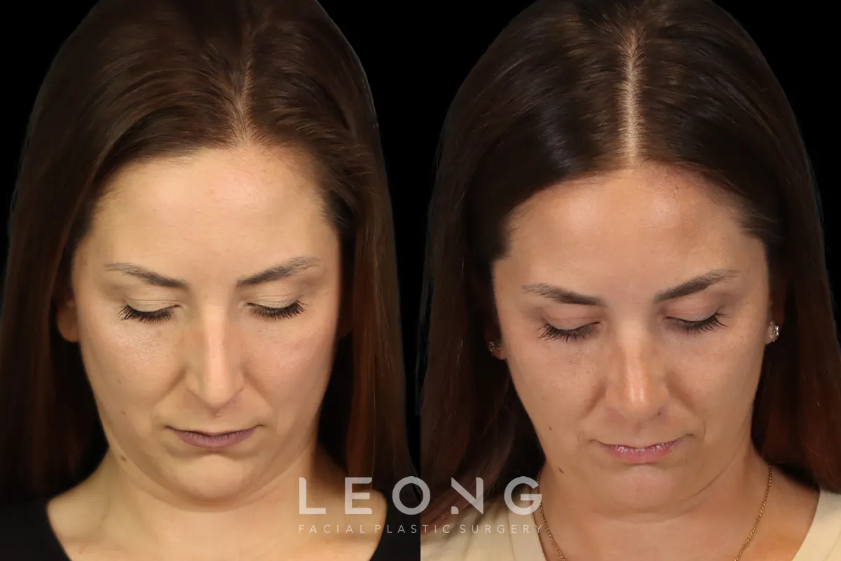 Rhinoplasty Before and After | Leong Facial Plastic Surgery