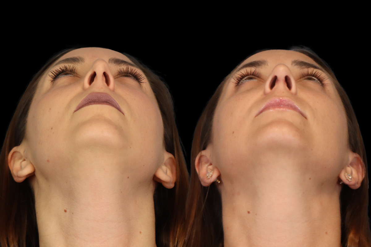 Rhinoplasty Before and After | Leong Facial Plastic Surgery