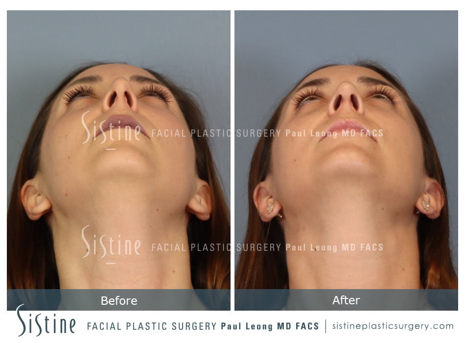 Rhinoplasty Before and After | Leong Facial Plastic Surgery