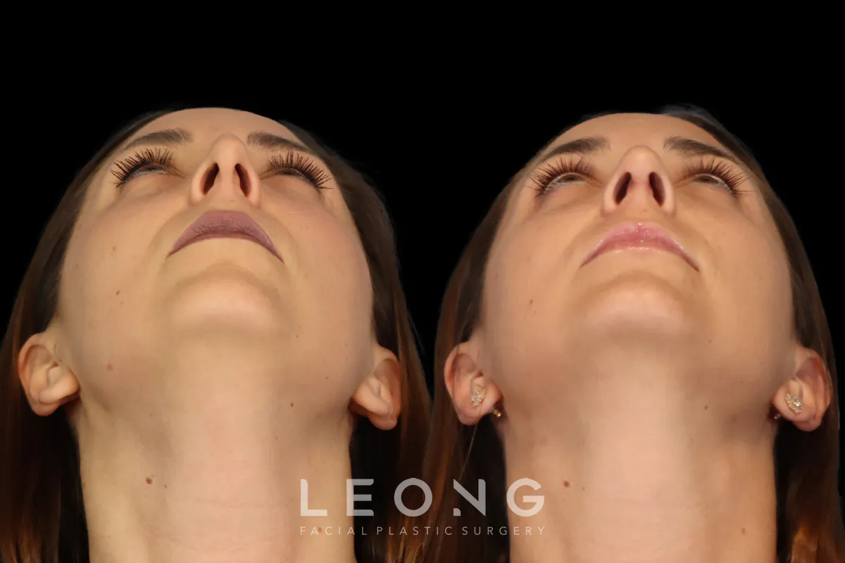Rhinoplasty Before and After | Leong Facial Plastic Surgery