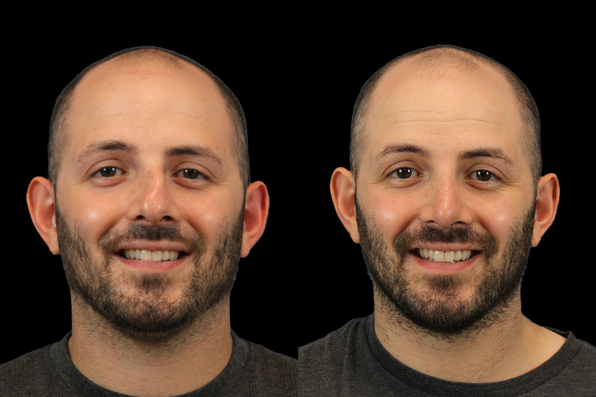 Rhinoplasty Before and After | Leong Facial Plastic Surgery