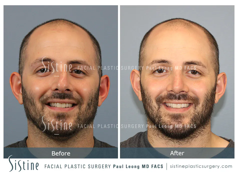 Rhinoplasty Before and After | Leong Facial Plastic Surgery