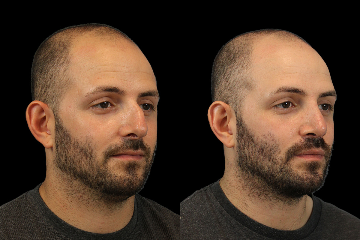 Rhinoplasty Before and After | Leong Facial Plastic Surgery
