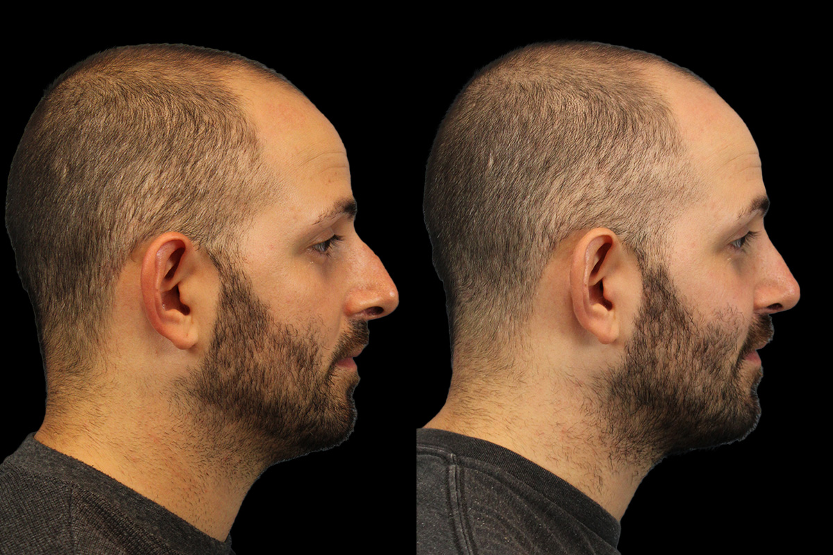 Rhinoplasty Before and After | Leong Facial Plastic Surgery