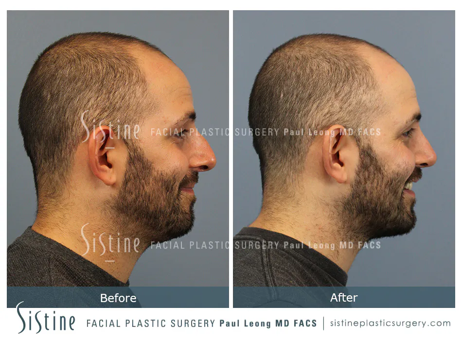 Rhinoplasty Before and After | Leong Facial Plastic Surgery