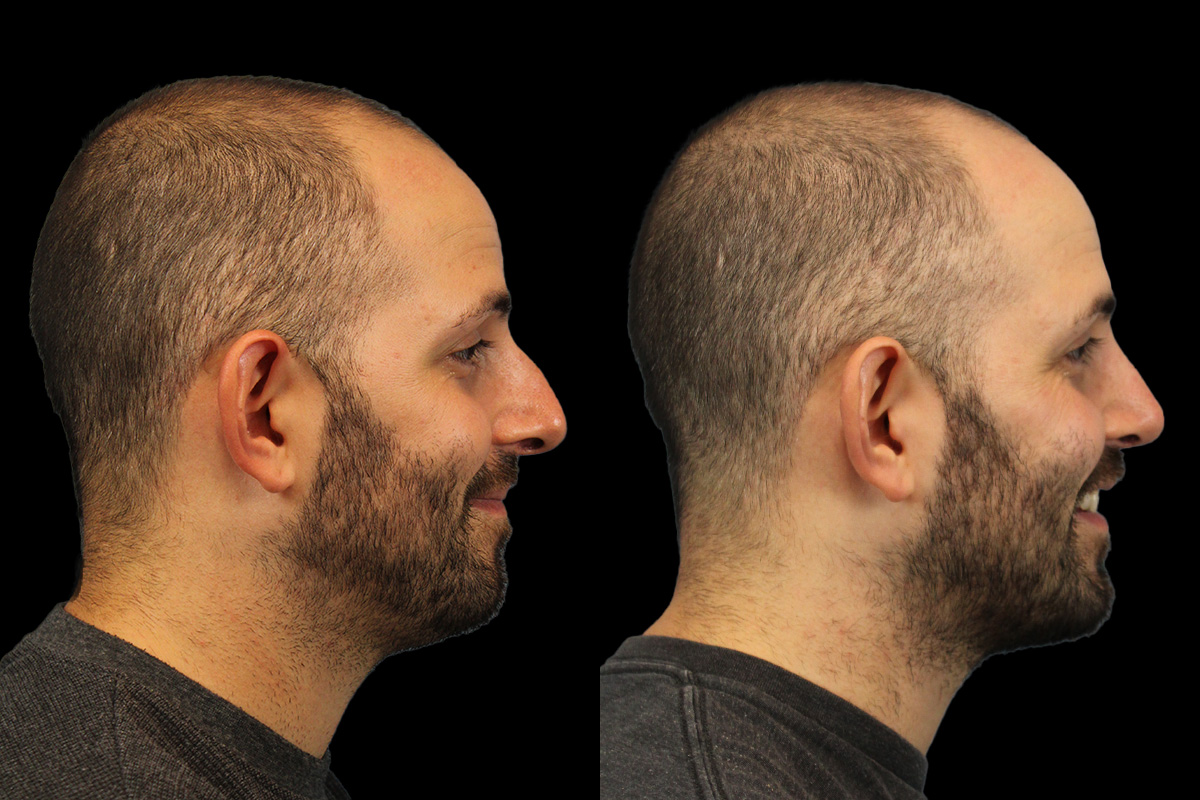 Rhinoplasty Before and After | Leong Facial Plastic Surgery