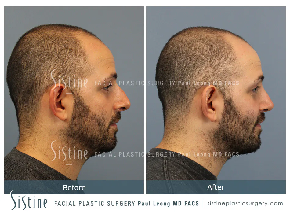 Rhinoplasty Before and After | Leong Facial Plastic Surgery