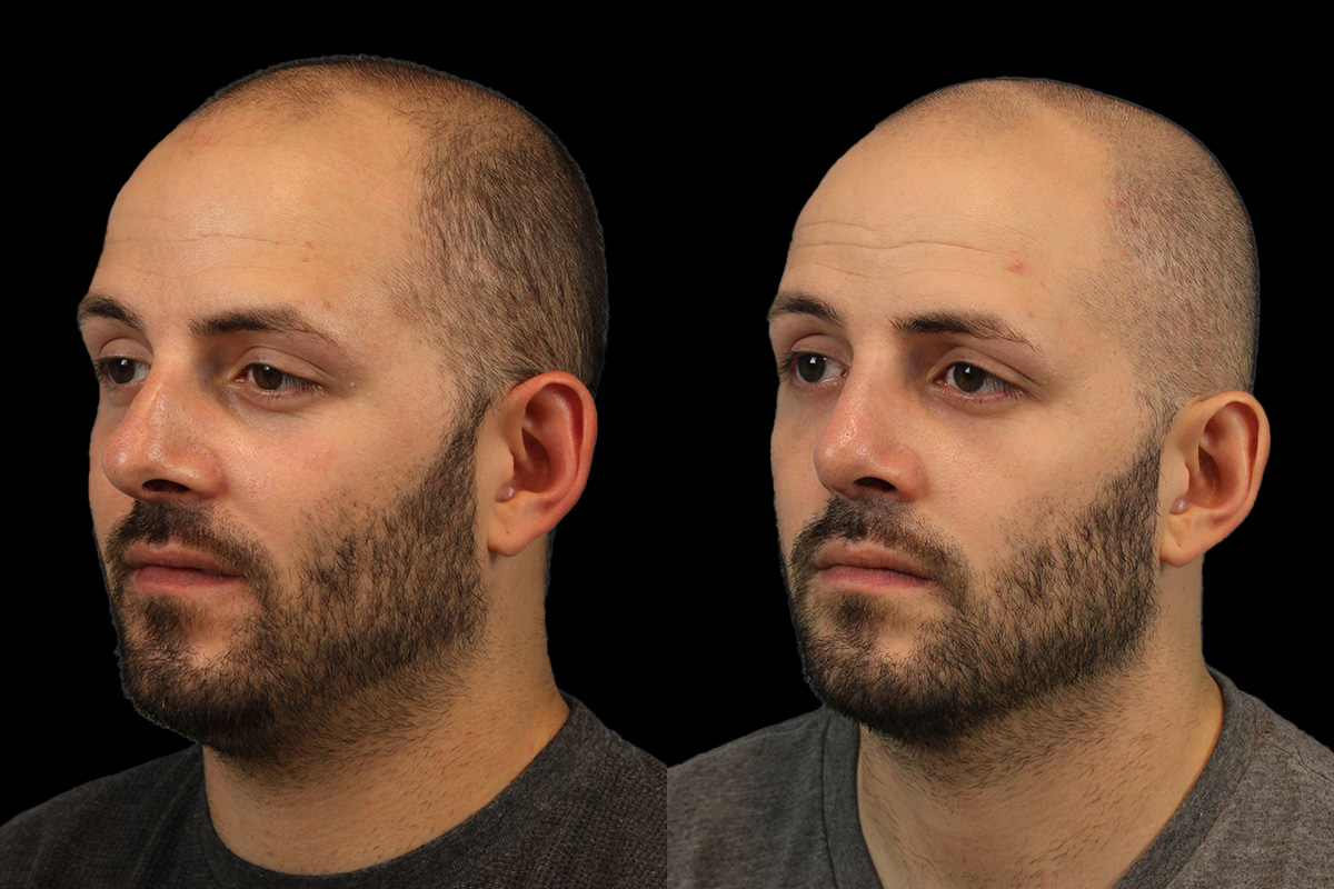Rhinoplasty Before and After | Leong Facial Plastic Surgery
