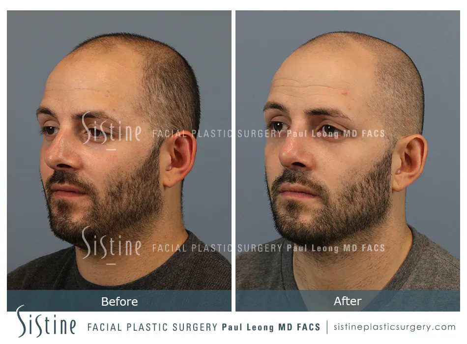 Rhinoplasty Before and After | Leong Facial Plastic Surgery