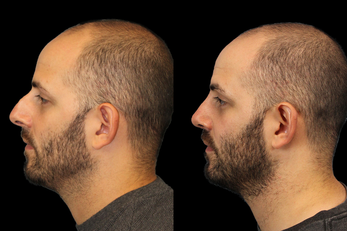Rhinoplasty Before and After | Leong Facial Plastic Surgery