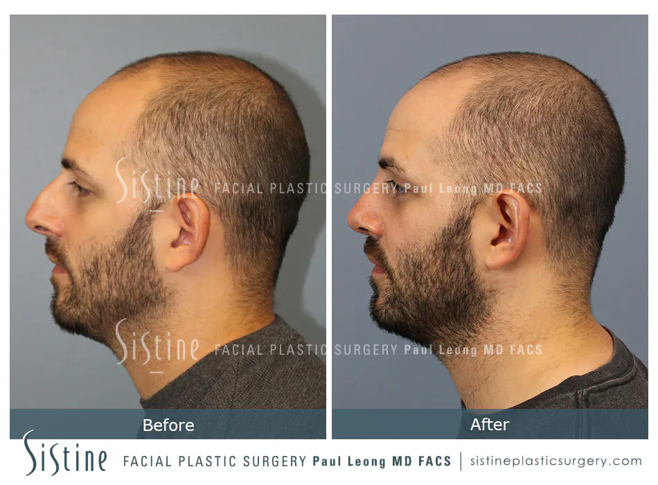 Rhinoplasty Before and After | Leong Facial Plastic Surgery