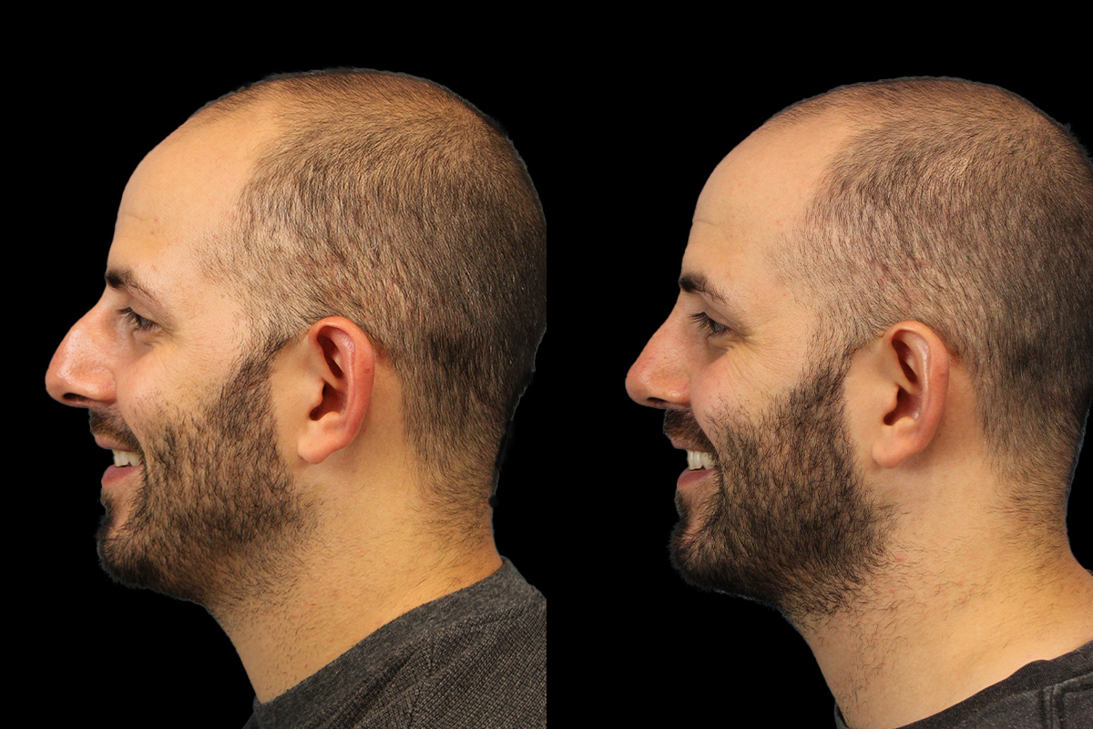 Rhinoplasty Before and After | Leong Facial Plastic Surgery