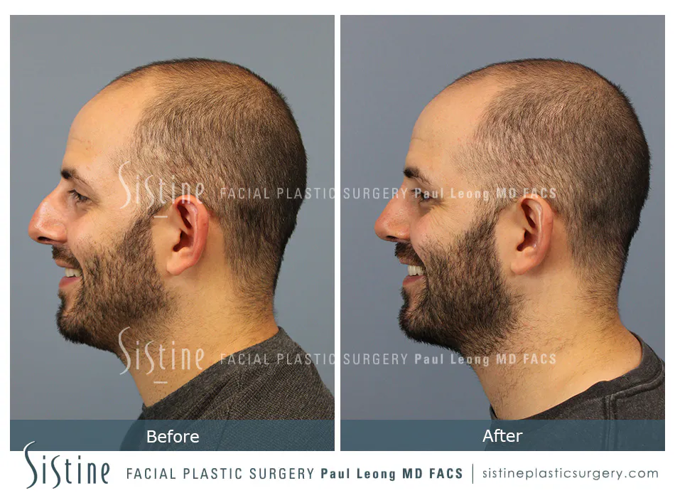 Rhinoplasty Before and After | Leong Facial Plastic Surgery