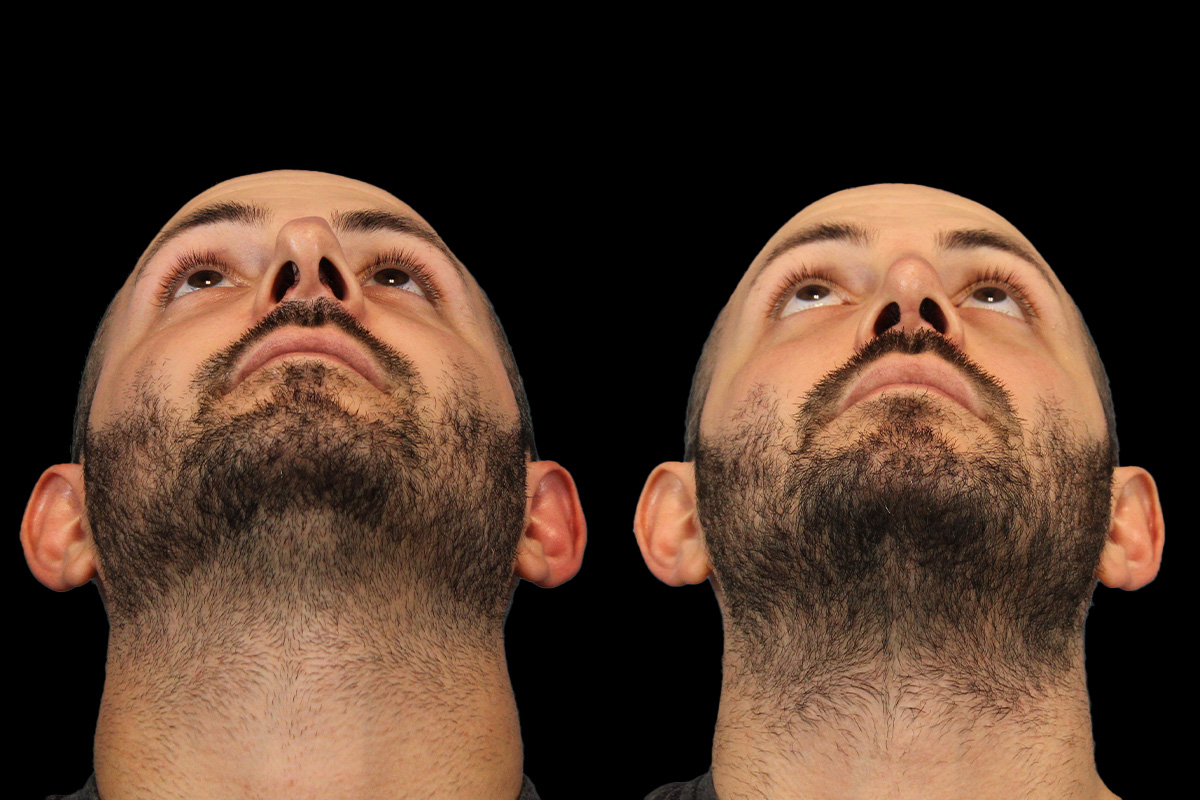 Rhinoplasty Before and After | Leong Facial Plastic Surgery