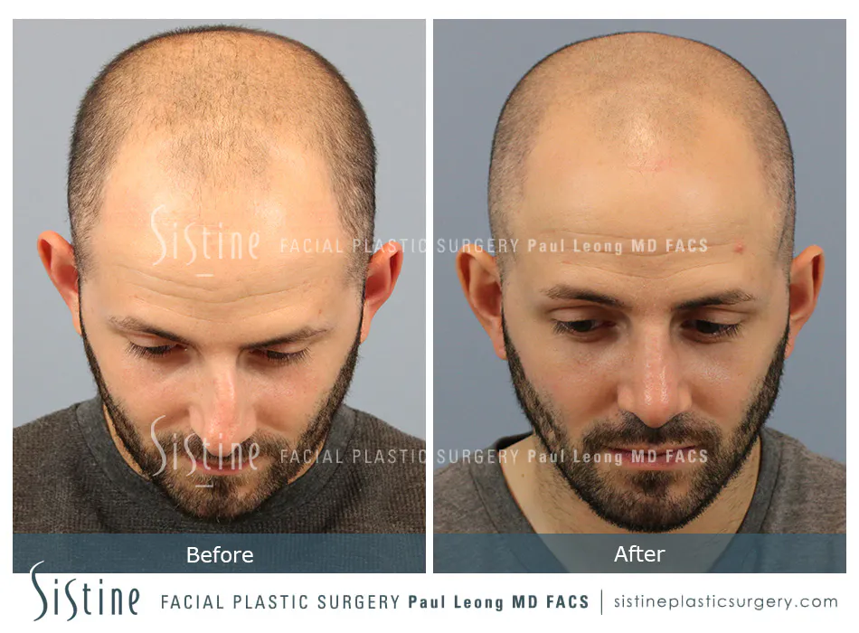 Rhinoplasty Before and After | Leong Facial Plastic Surgery