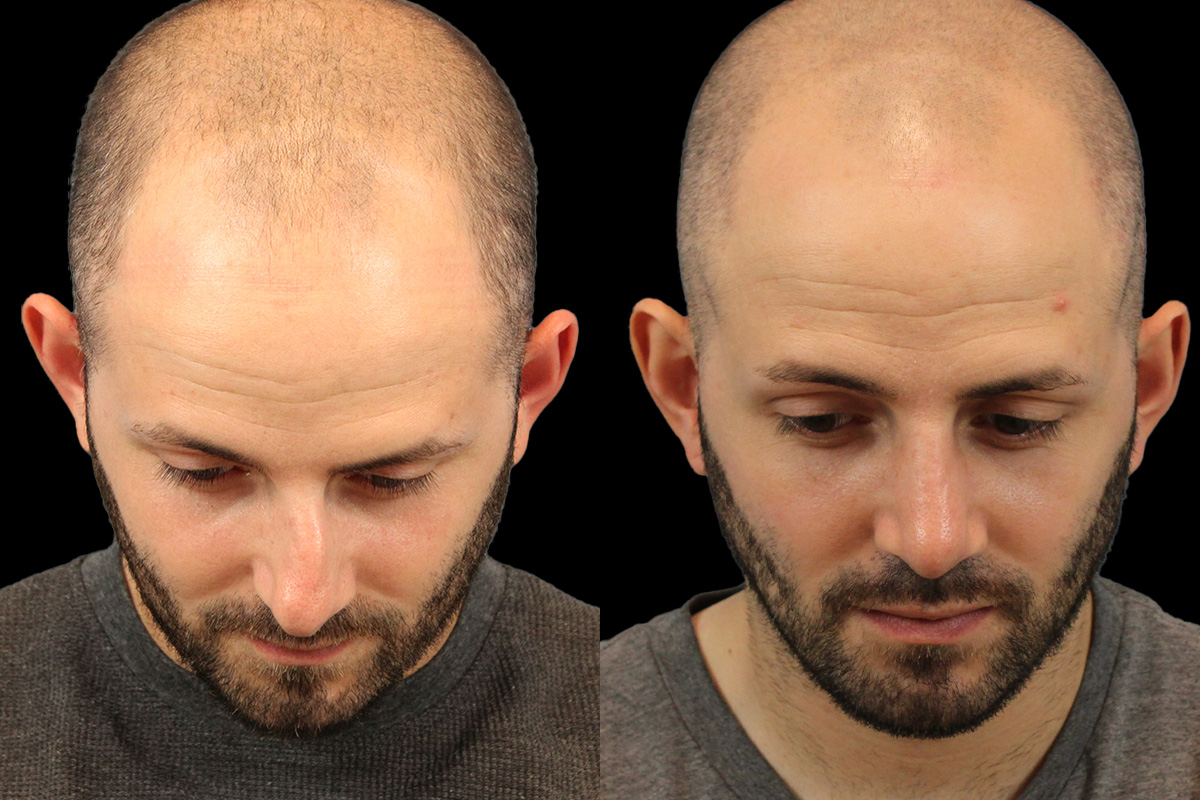 Rhinoplasty Before and After | Leong Facial Plastic Surgery