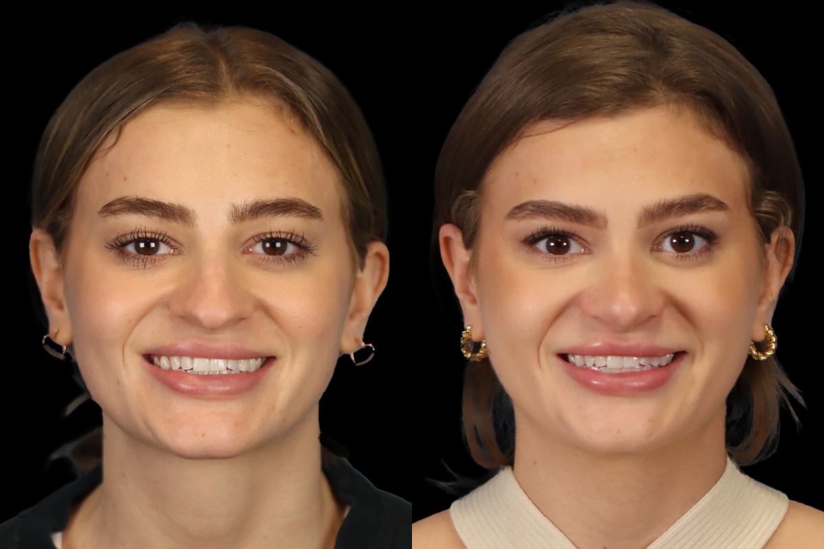 Rhinoplasty Before and After | Leong Facial Plastic Surgery