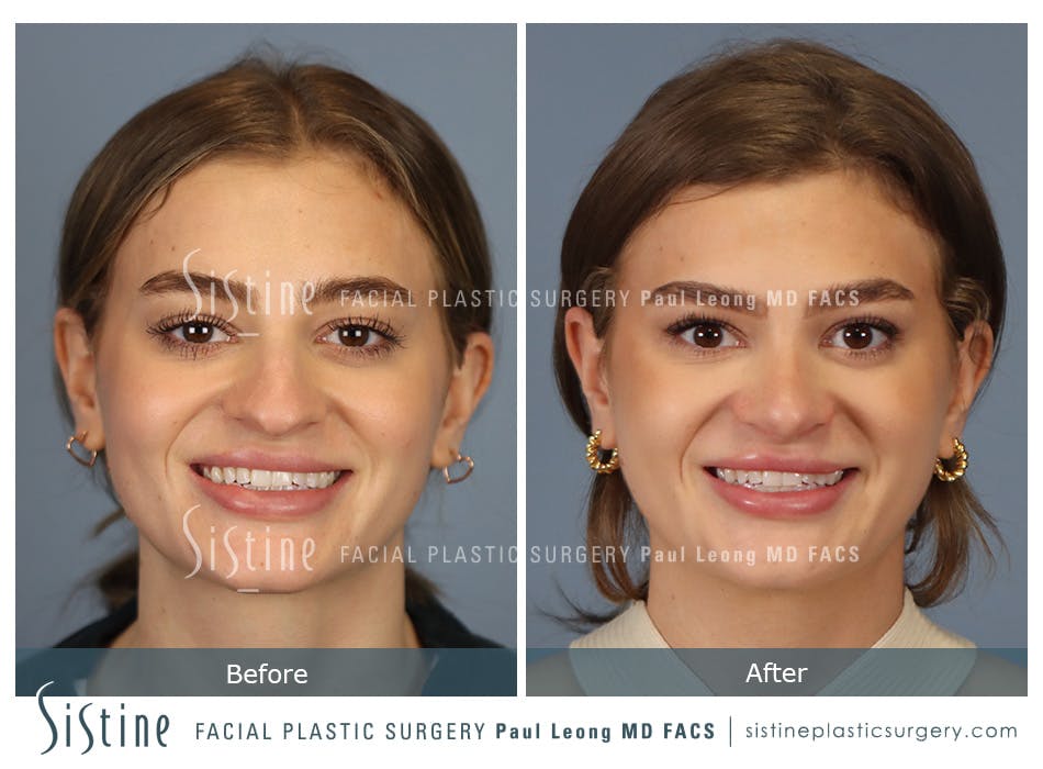 Rhinoplasty Before and After | Leong Facial Plastic Surgery