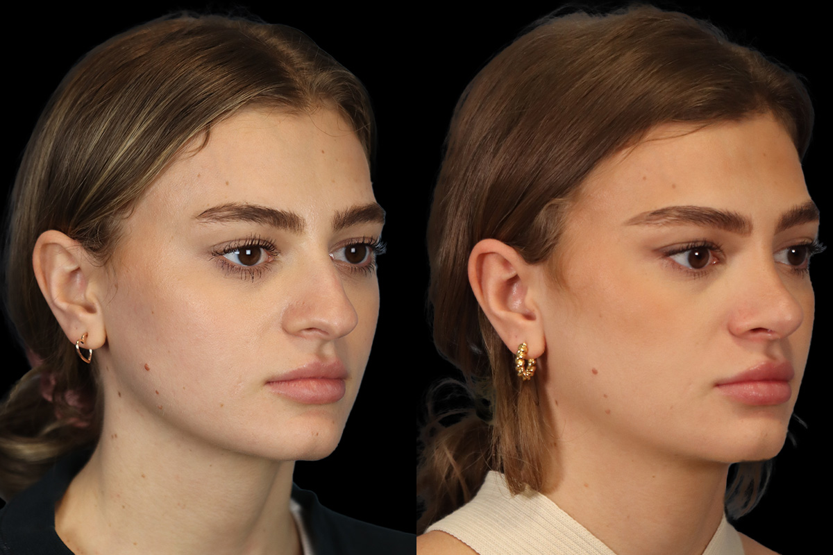 Rhinoplasty Before and After | Leong Facial Plastic Surgery