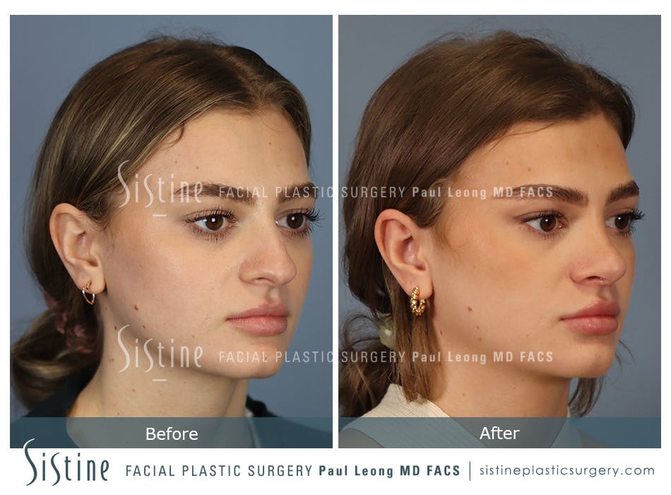 Rhinoplasty Before and After | Leong Facial Plastic Surgery