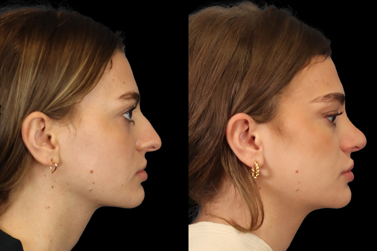 Rhinoplasty Before and After | Leong Facial Plastic Surgery