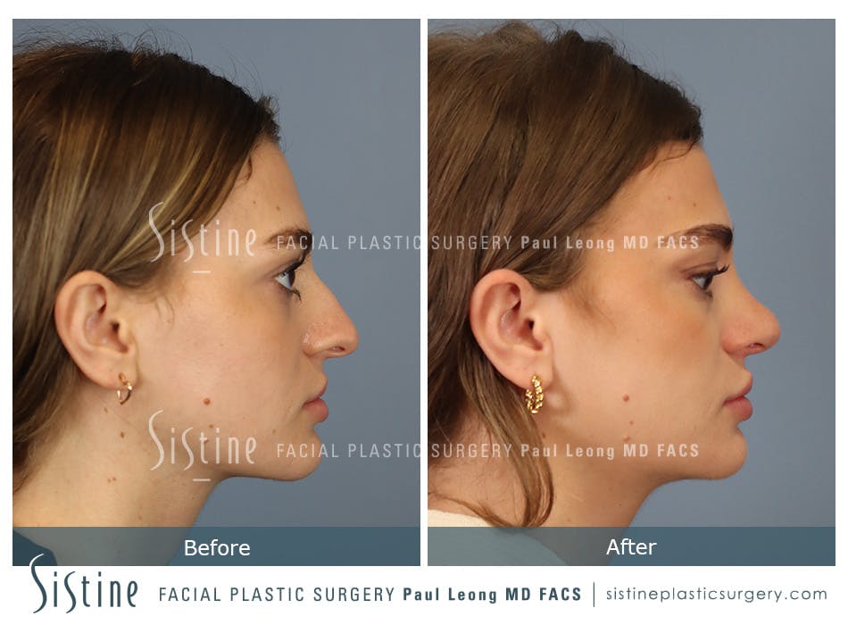 Rhinoplasty Before and After | Leong Facial Plastic Surgery