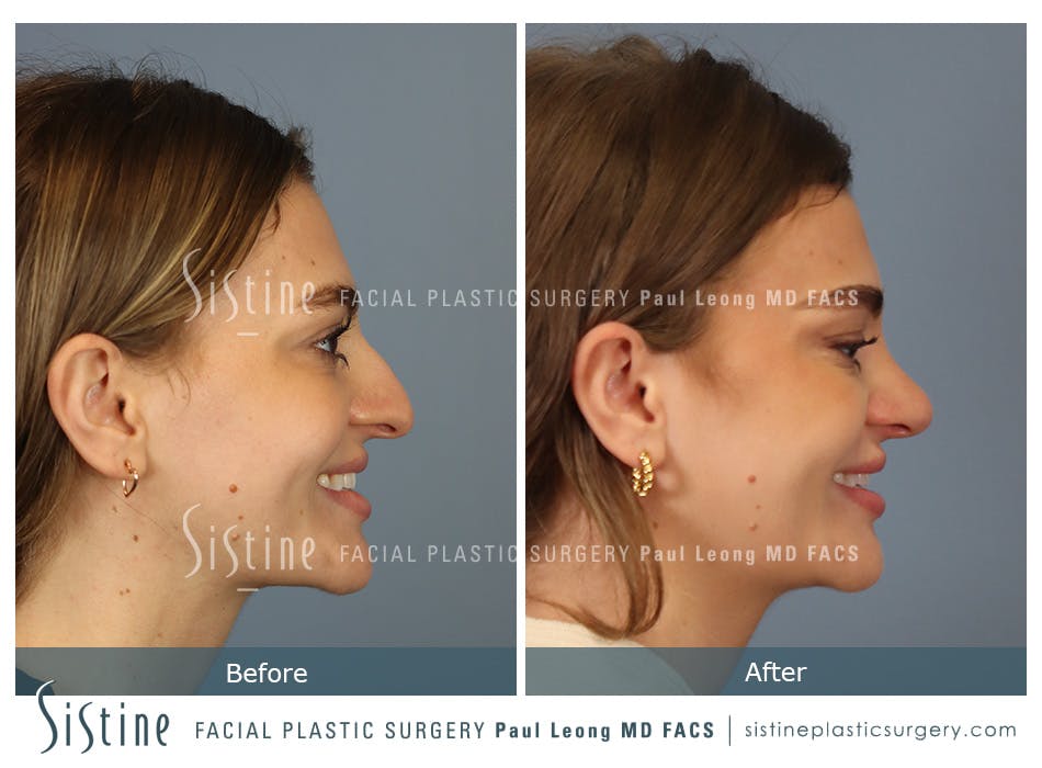 Rhinoplasty Before and After | Leong Facial Plastic Surgery