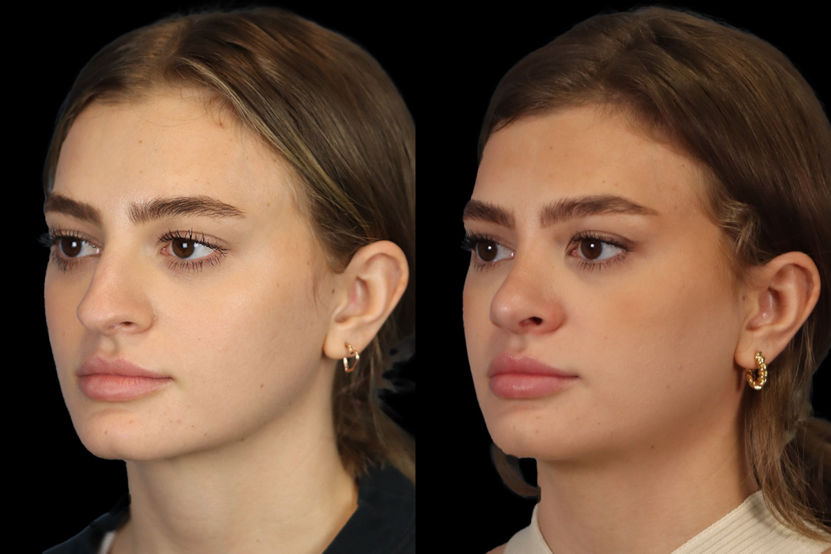 Rhinoplasty Before and After | Leong Facial Plastic Surgery