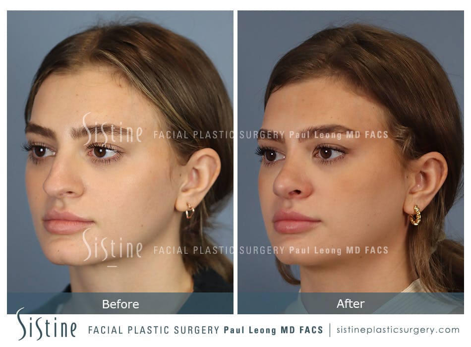Rhinoplasty Before and After | Leong Facial Plastic Surgery