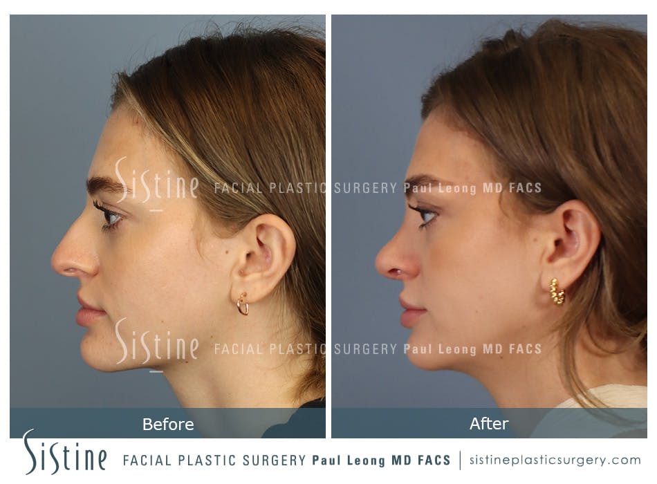 Rhinoplasty Before and After | Leong Facial Plastic Surgery