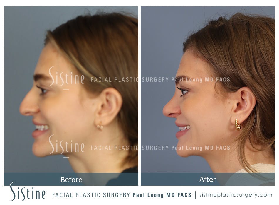 Rhinoplasty Before and After | Leong Facial Plastic Surgery