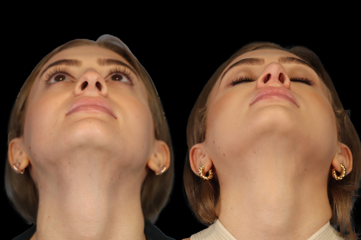 Rhinoplasty Before and After | Leong Facial Plastic Surgery