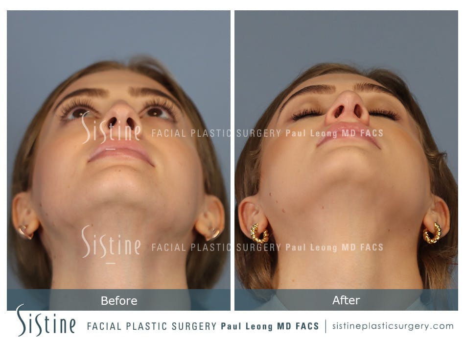 Rhinoplasty Before and After | Leong Facial Plastic Surgery