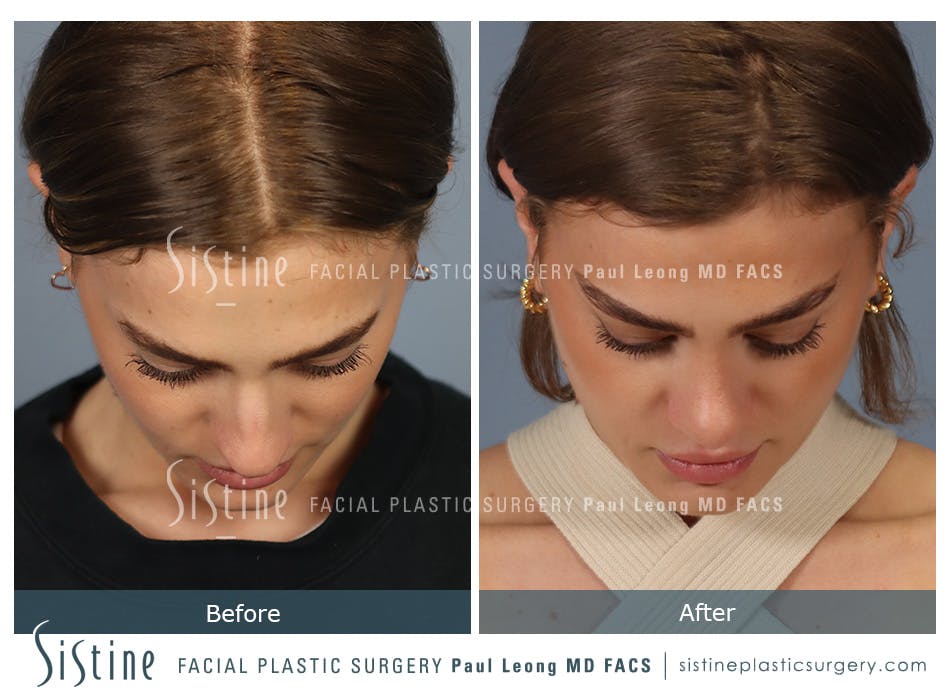 Rhinoplasty Before and After | Leong Facial Plastic Surgery