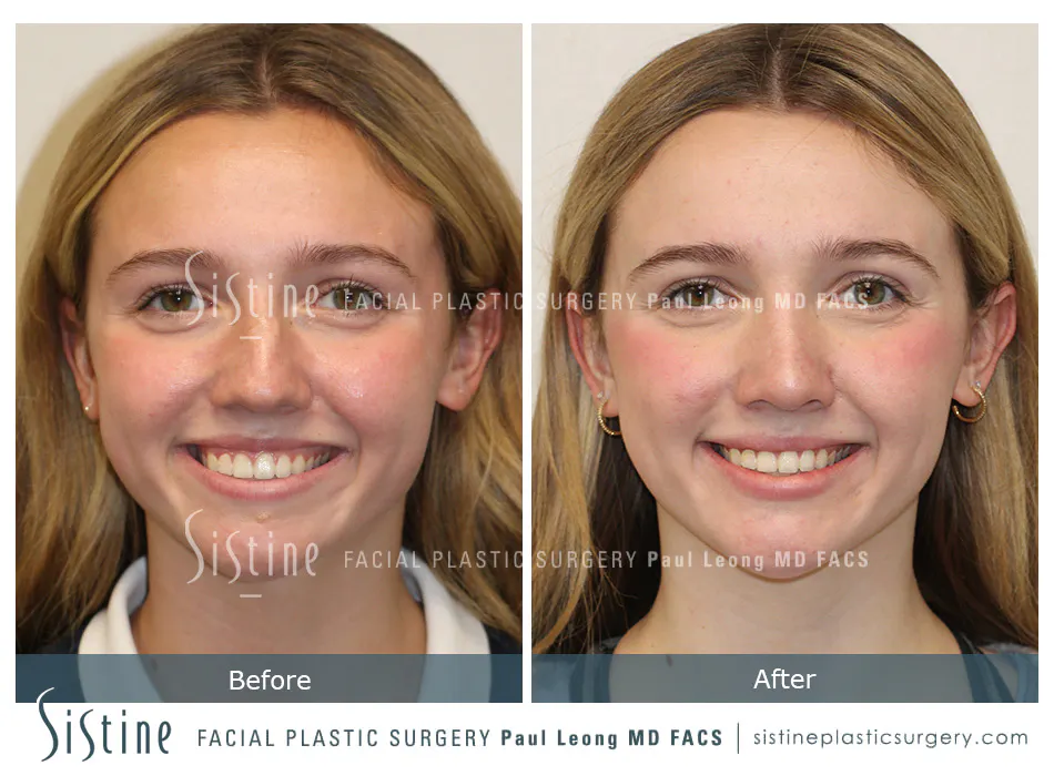Rhinoplasty Before and After | Leong Facial Plastic Surgery