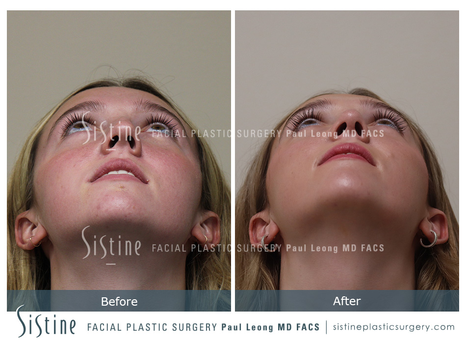 Rhinoplasty Before and After | Leong Facial Plastic Surgery