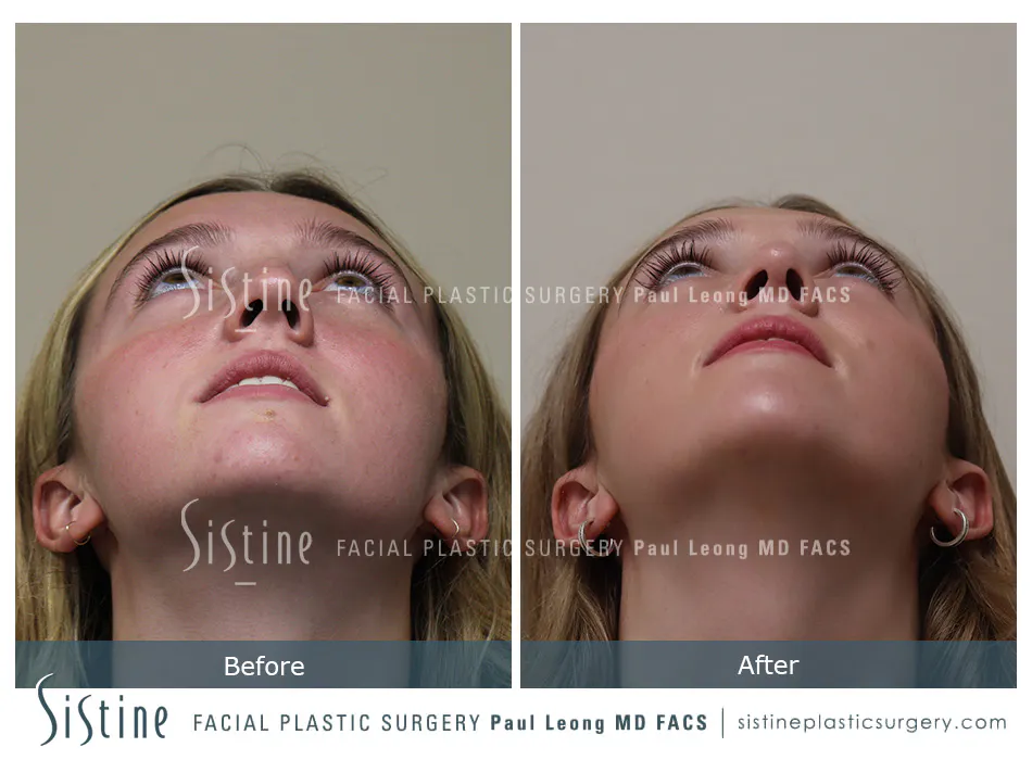 Rhinoplasty Before and After | Leong Facial Plastic Surgery