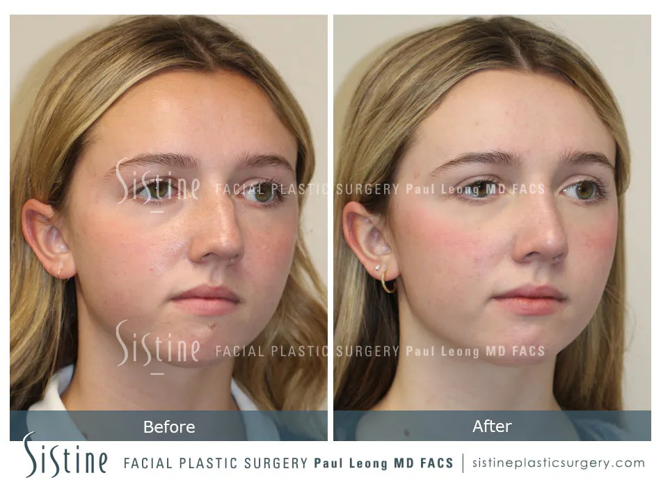 Rhinoplasty Before and After | Leong Facial Plastic Surgery