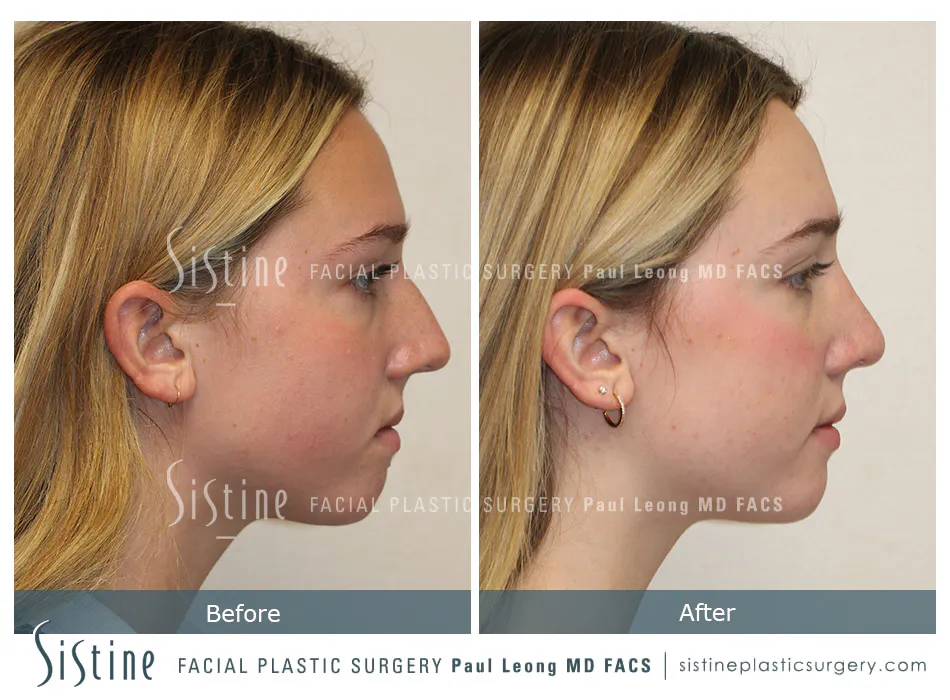 Rhinoplasty Before and After | Leong Facial Plastic Surgery
