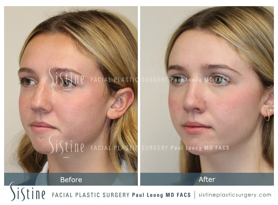 Rhinoplasty Before and After | Leong Facial Plastic Surgery